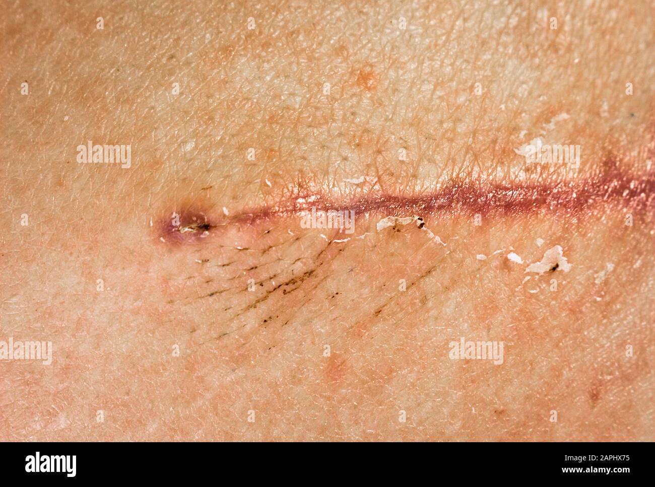 Scabs High Resolution Stock Photography and Images Alamy
