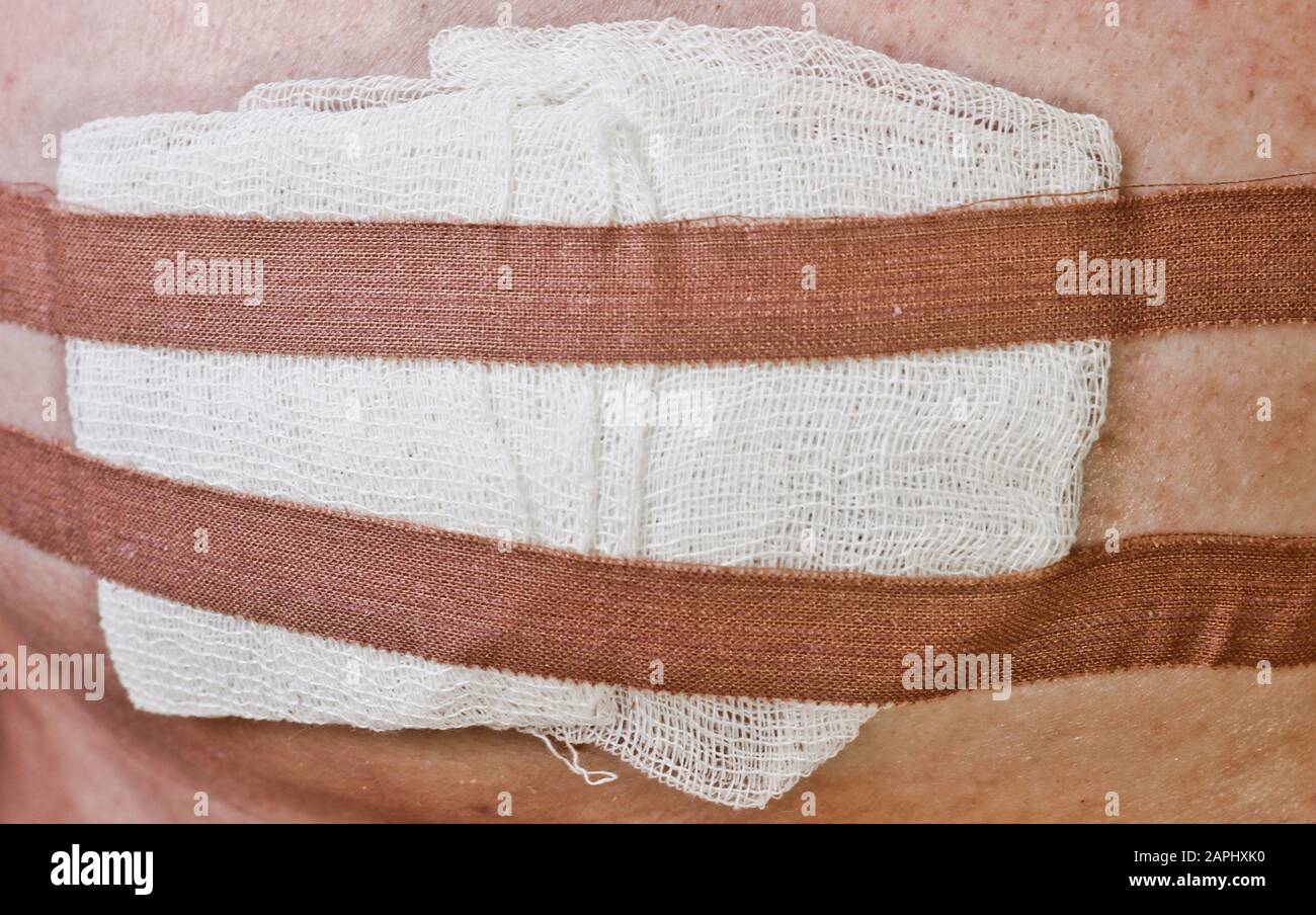 Gauze dressing and hypoallergenic adhesive plaster on the wound