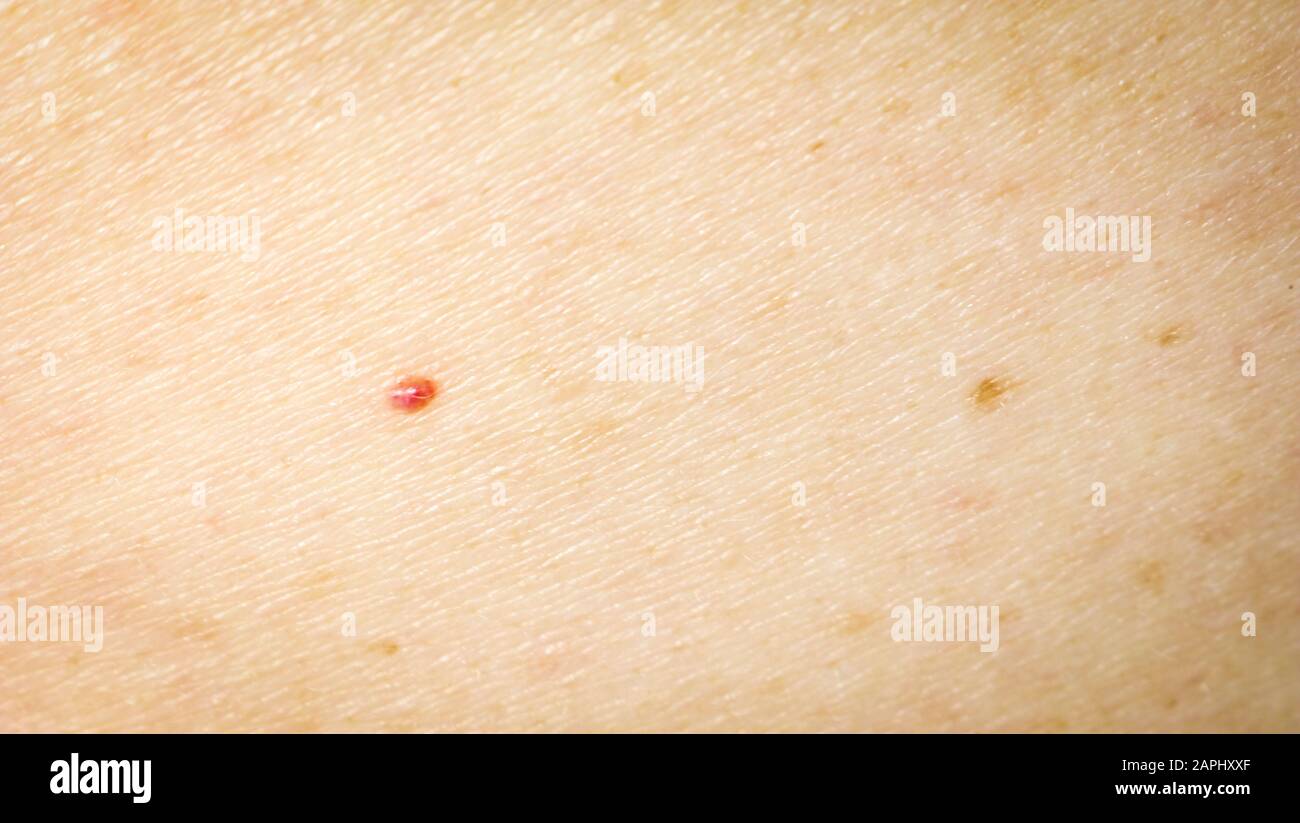 The Texture Of Human Skin With A Mole Freckles And Age Spots Stock Photo Alamy