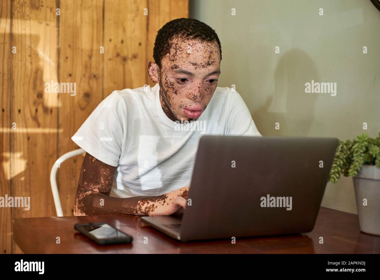 Young man with vitiligo working on his computer in a cafeteria Stock Photo