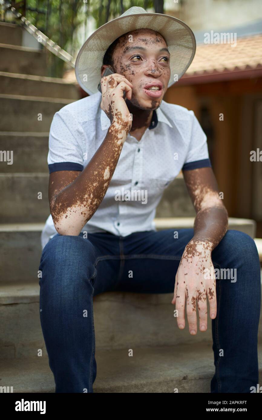 Young man with vitiligo using smartphone Stock Photo