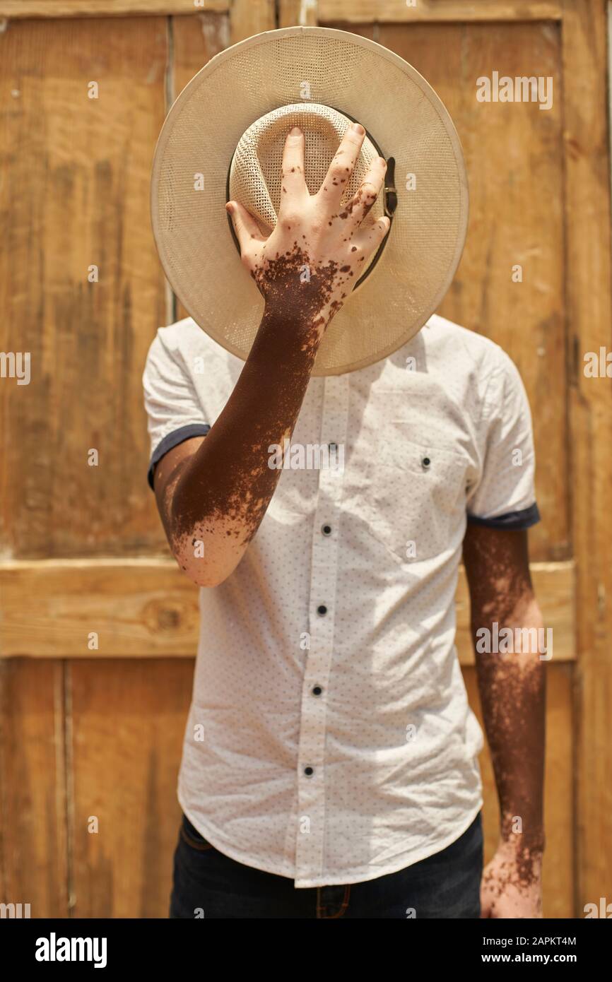 Portrait of young man with vitiligo covering his face with a hat Stock Photo