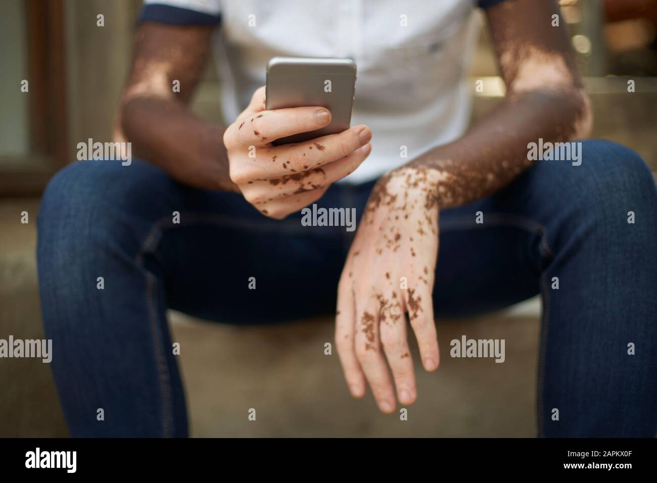 Young man with vitiligo using smartphone Stock Photo