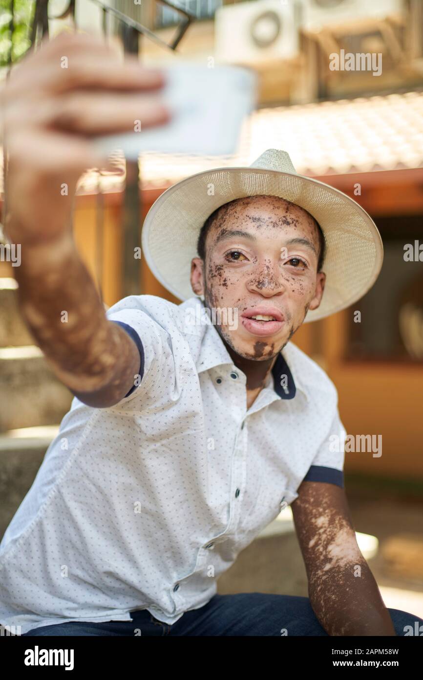 Young man with vitiligo using smartphone and taking a selfie Stock Photo