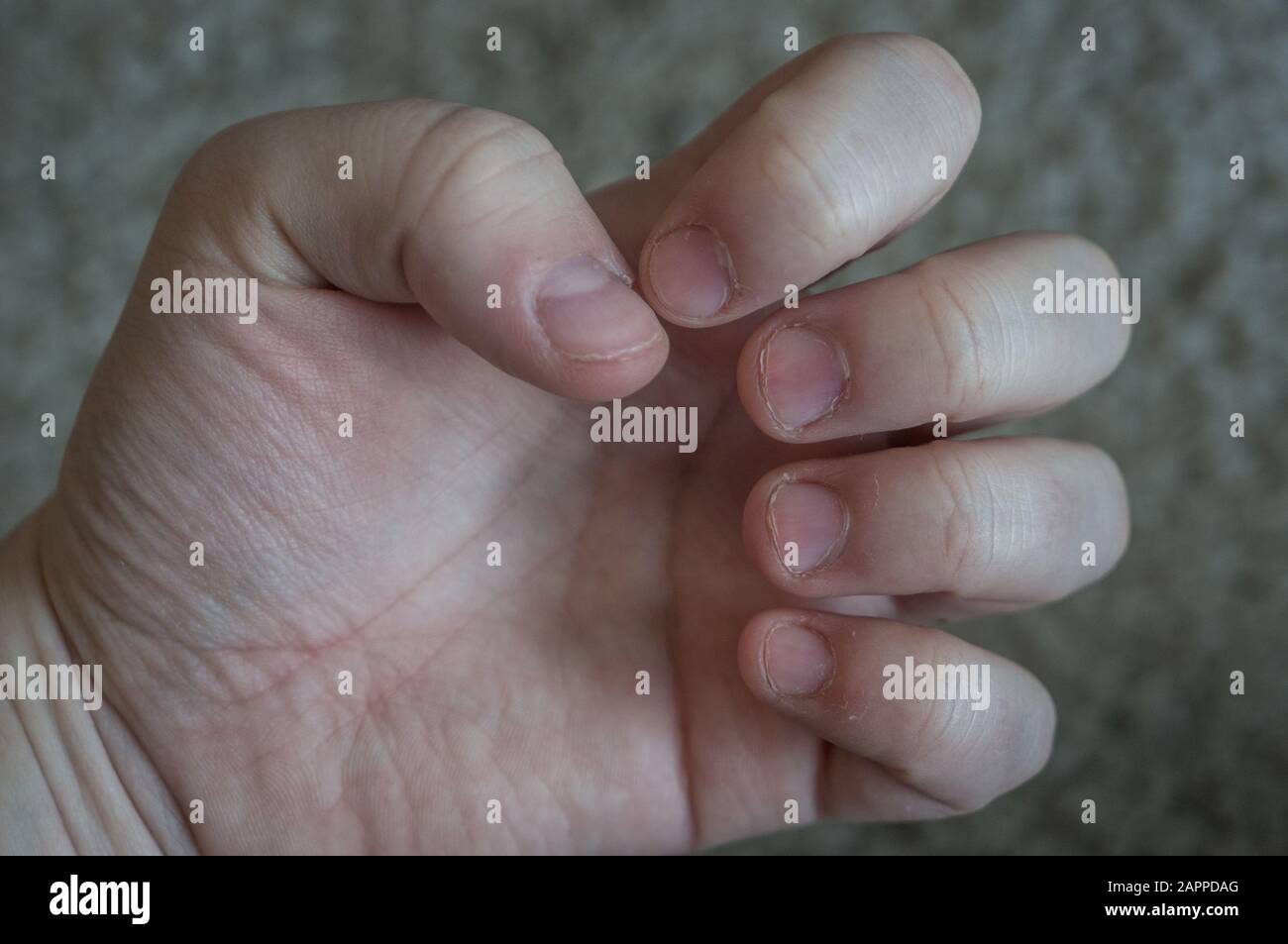 Damaged nails on hand from biting and skin