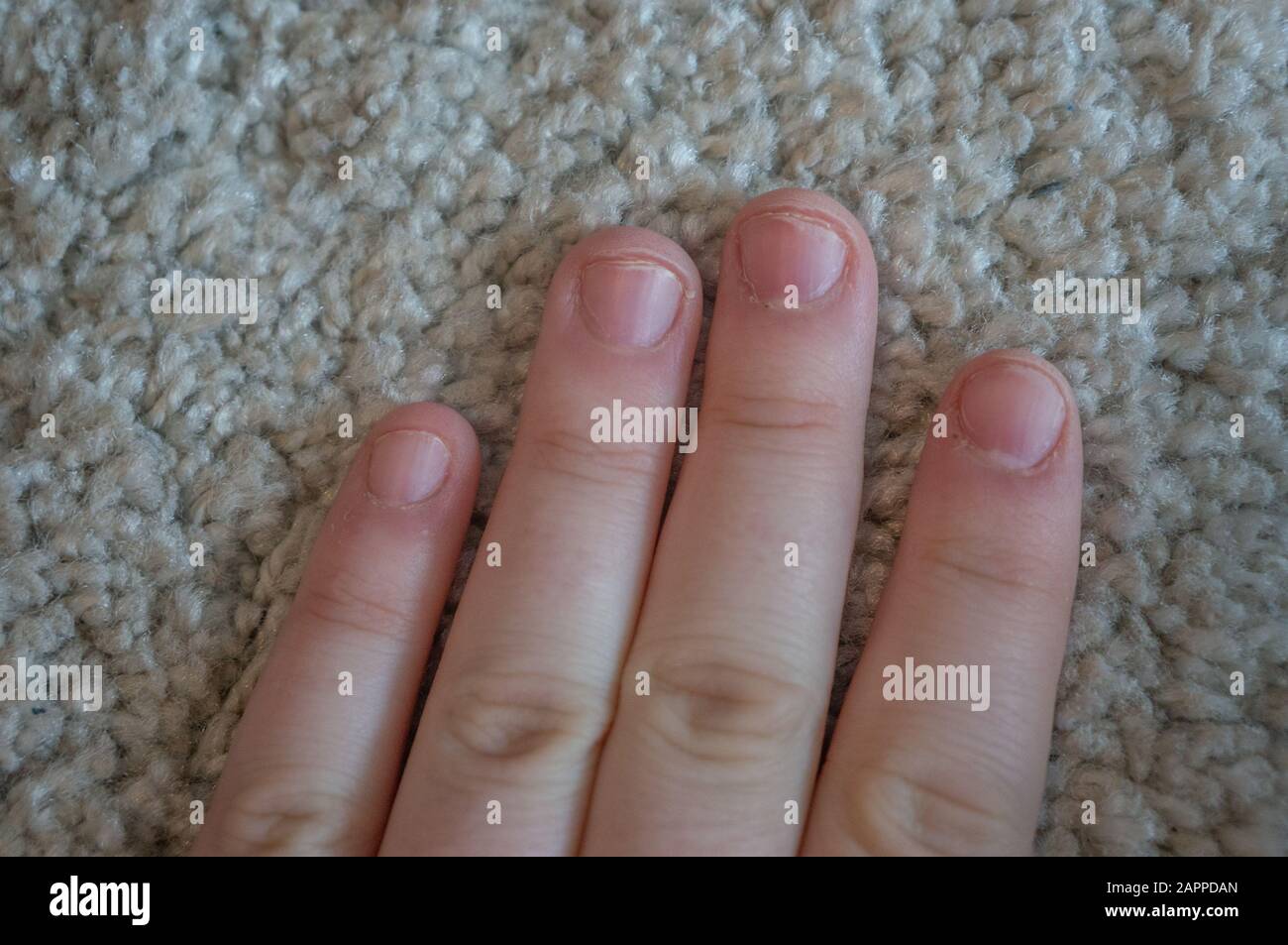 Finger nails damaged due to biting and compulsive skin picking disorder