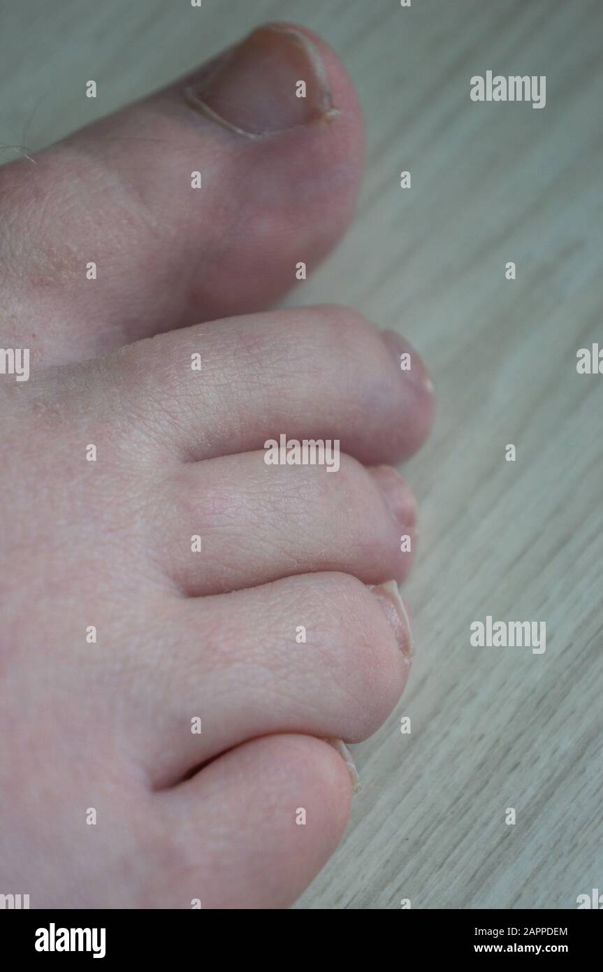 Close up of toes with uncut growing toenails and some hair on bigtoe