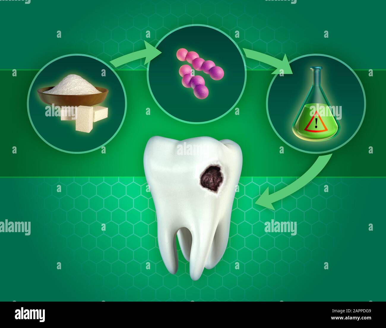 The process leading to the formation of dental cavities, caused by the production of acids by sugar consuming bacteria. 3D illustration. Stock Photo