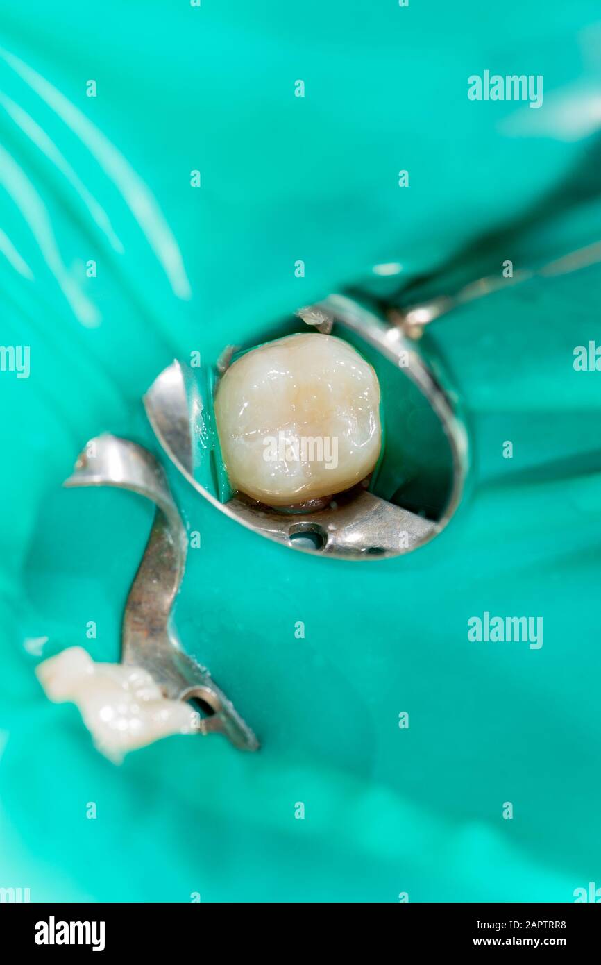 Dental caries. Filling with dental composite photopolymer material using rabbders. The concept of dental treatment in a dental clinic Stock Photo