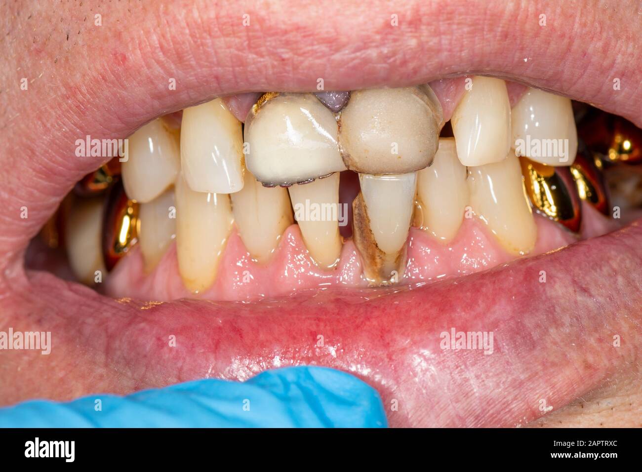 Closeup of macro dental calculus and dental plaque. Oral hygiene in