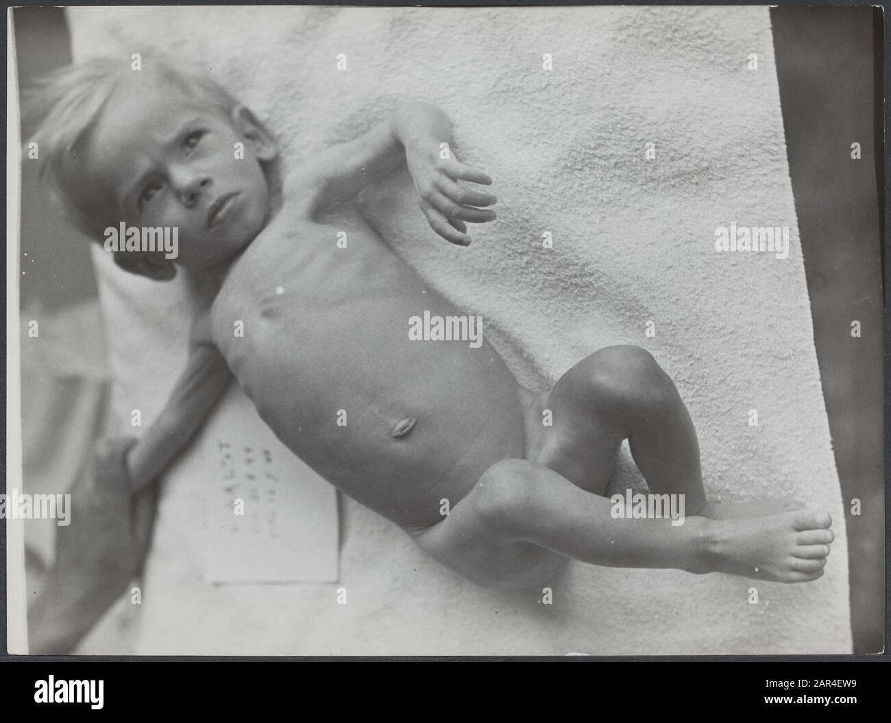 Hunger Winter War Netherlands Hunger winter. Child with growth disorder. On namecard ...