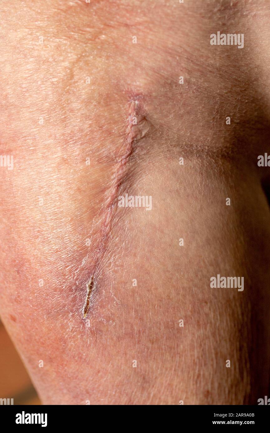 A middle aged woman's flank bears a scar from hip replacement surgery at a Los Angeles hospital. Stock Photo
