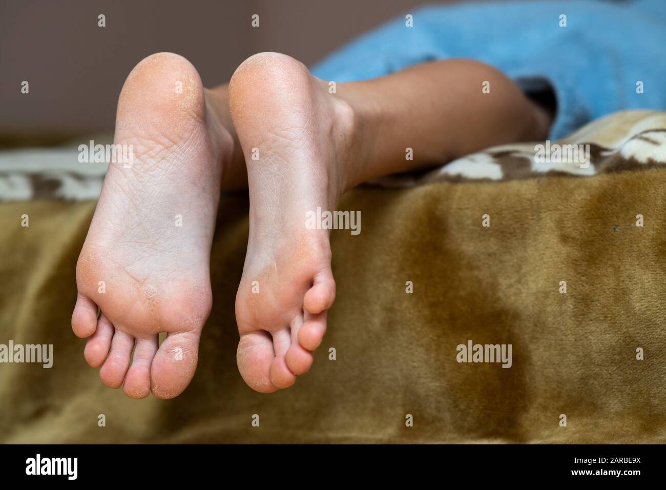cracked skin under big toe
