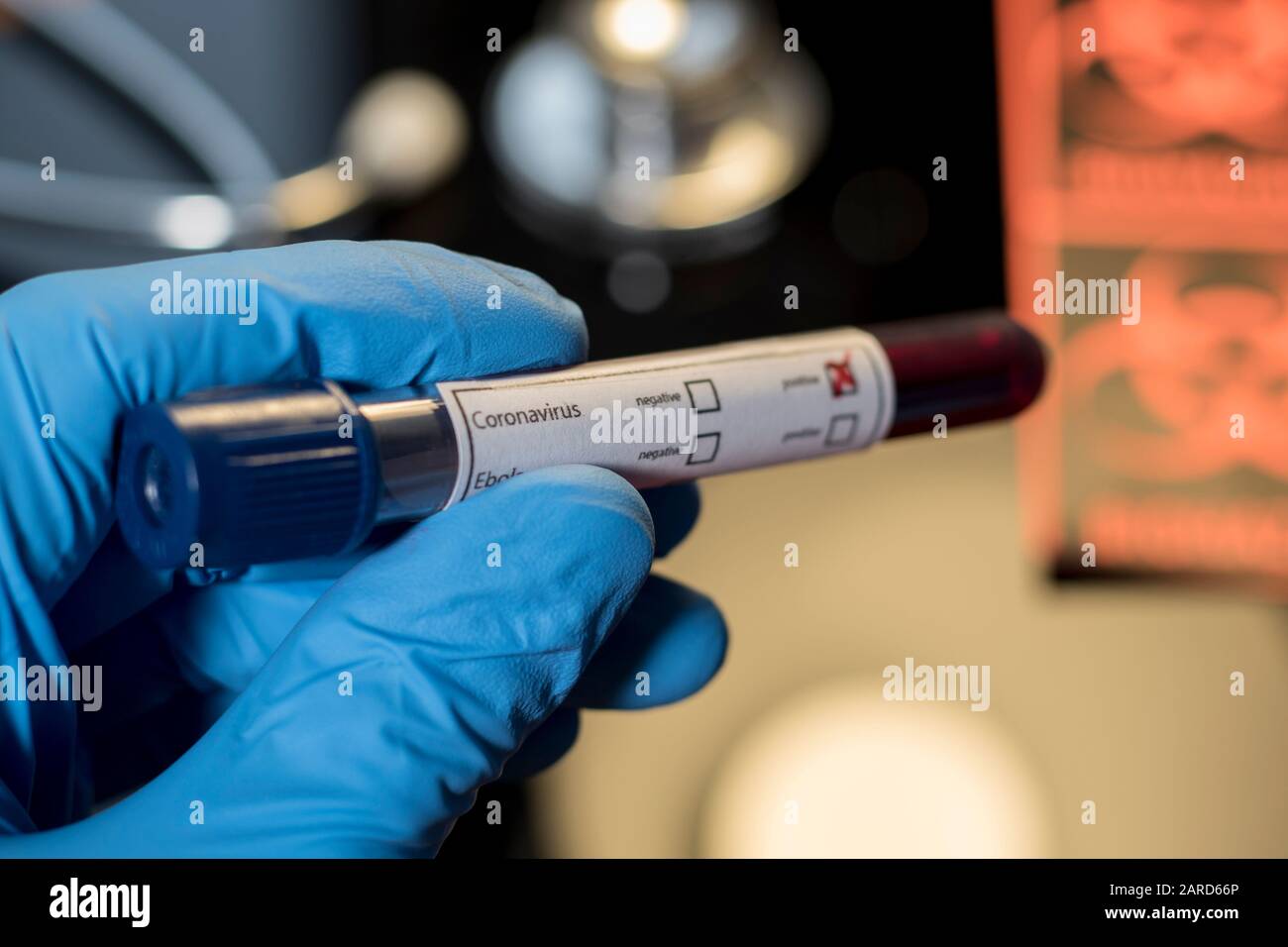 Coronavirus positive blood test sample for sick patient. Infected blood sample of Wuhan coronavirus. Research laboratory test results for respiratory Stock Photo
