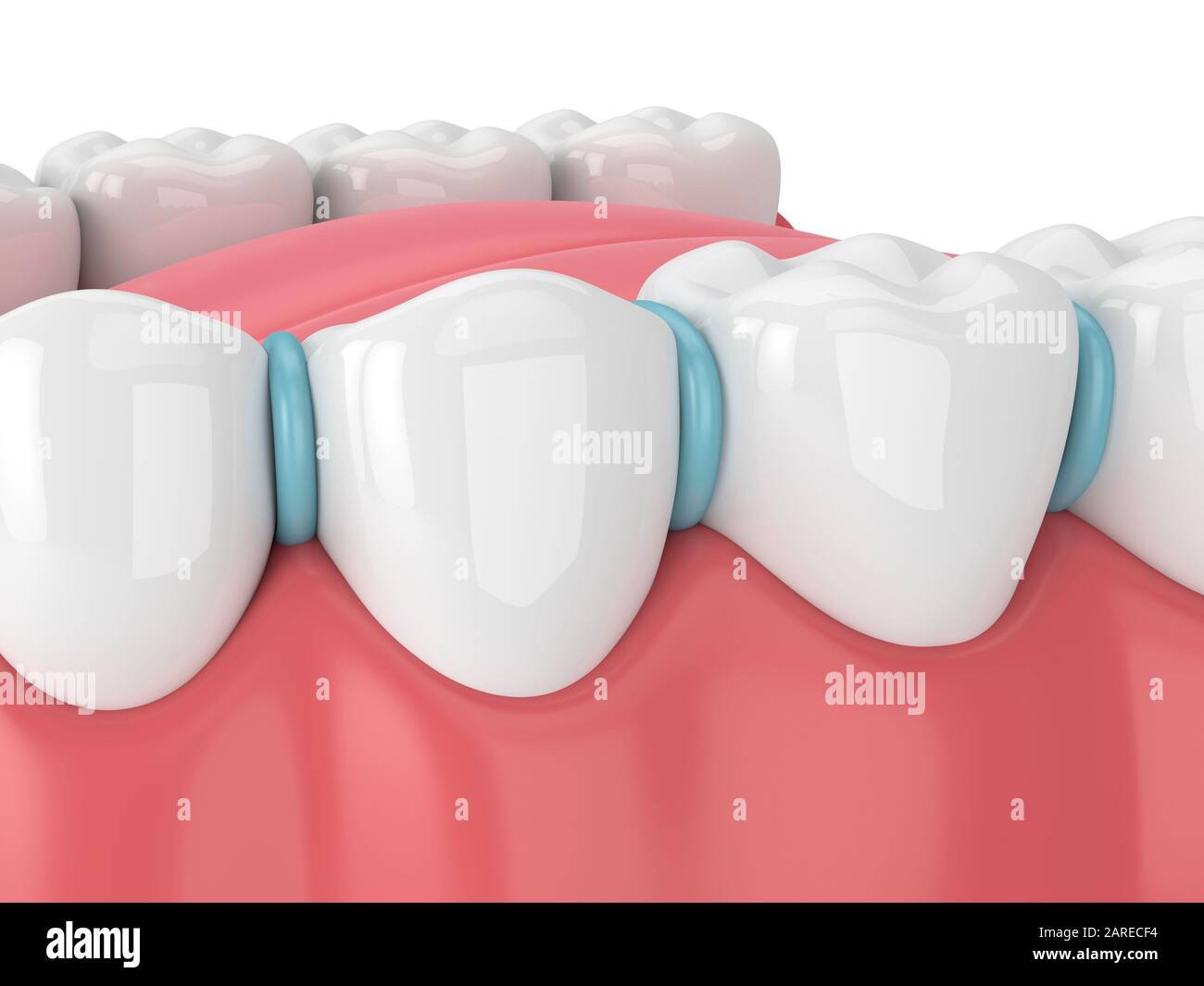 3d render of rubber separator between teeth. Preparation for braces