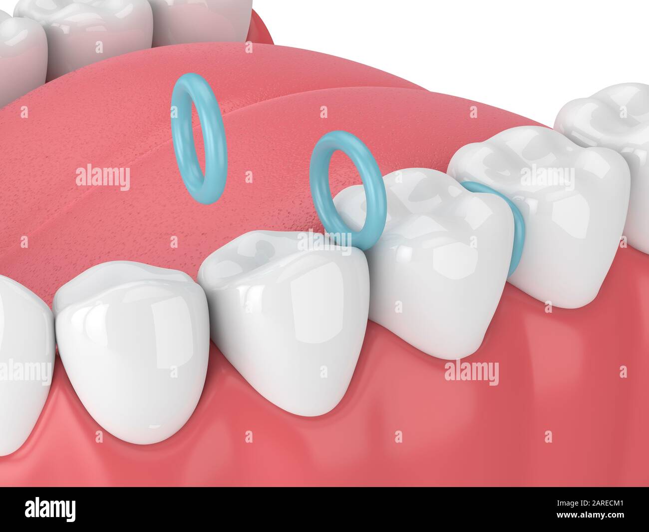 3d render of rubber separators between teeth. Preparation for braces