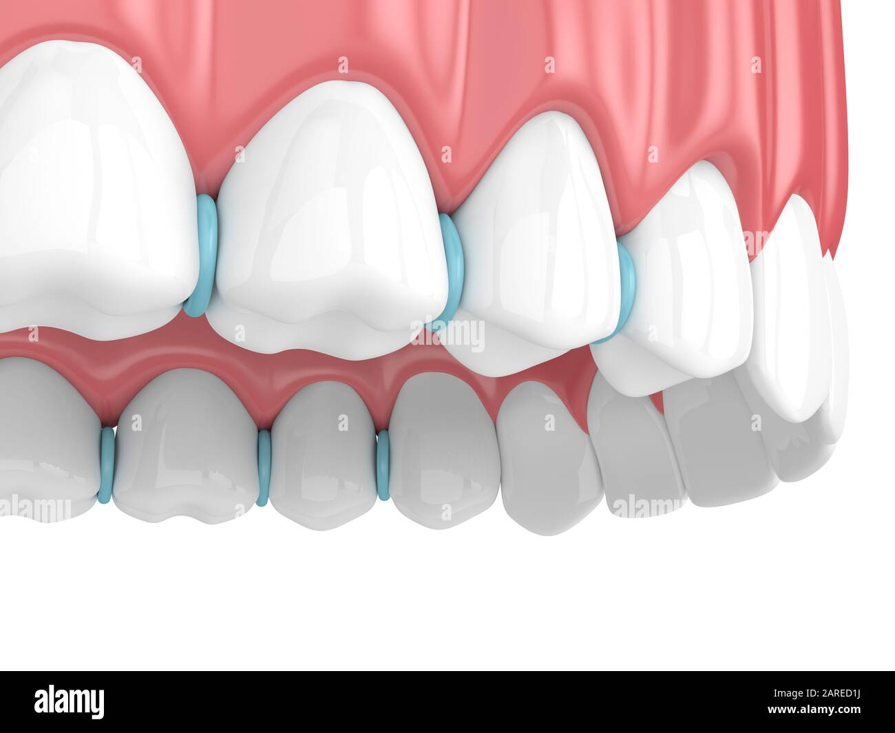 3d render of rubber separators between teeth. Preparation for braces