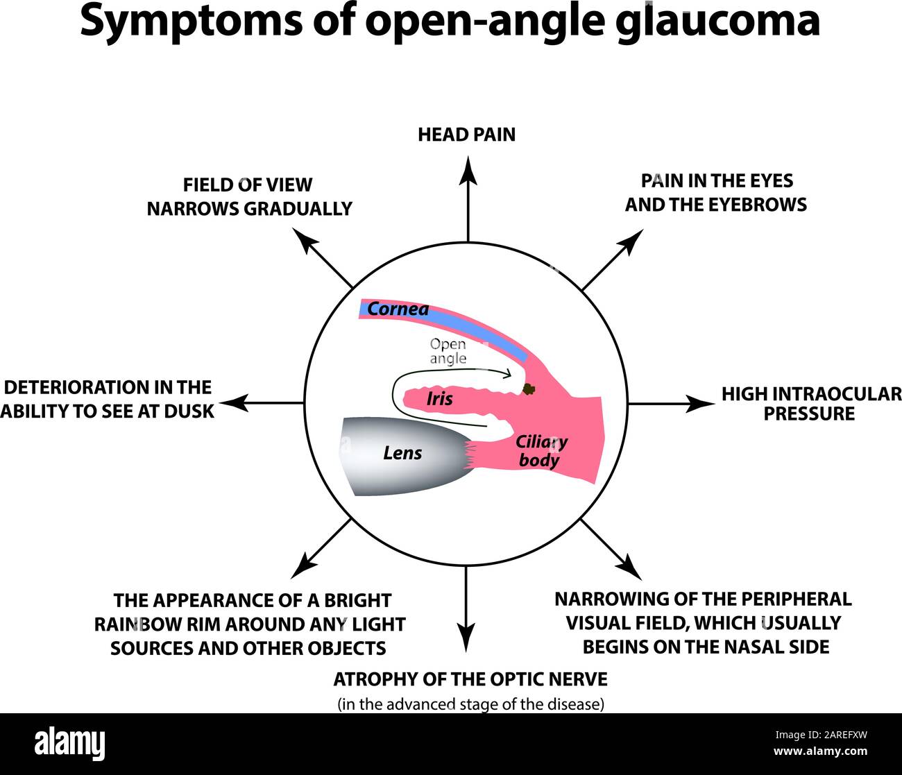 Symptoms of openangle World day. The anatomical structure of the eye