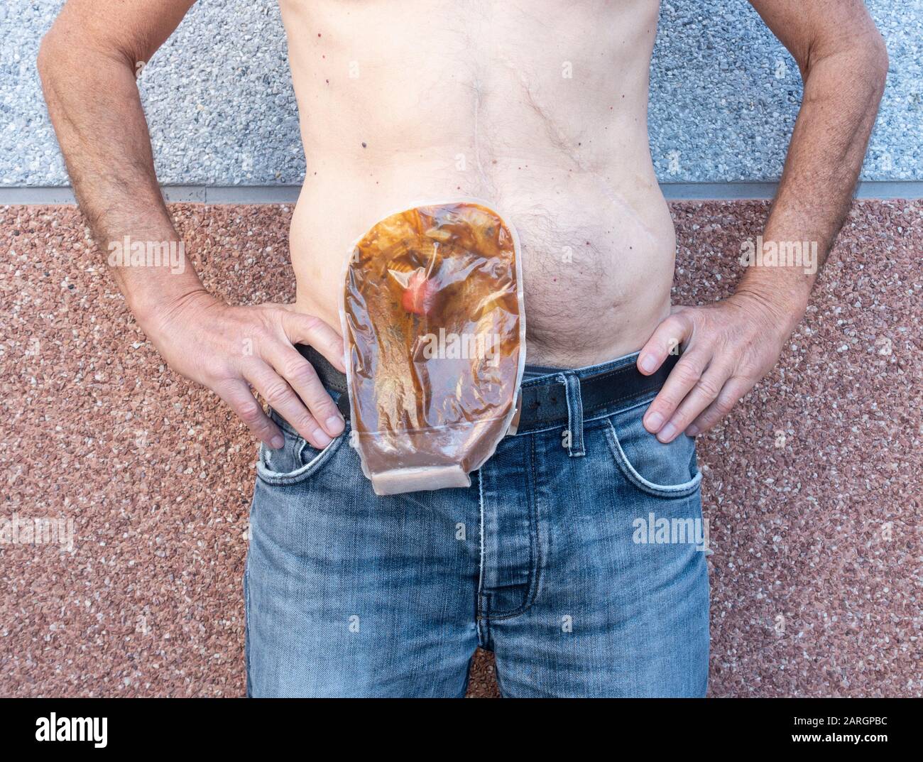 Mature man with stoma wearing transparent ileostomy bag. See image