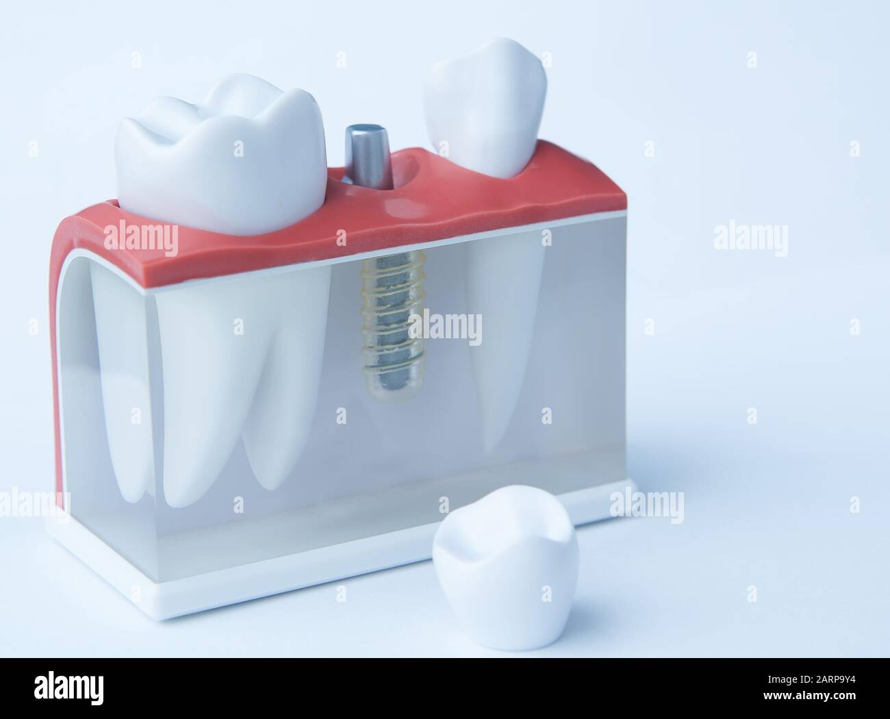 This model shows that teeth have been capped and the stainless pin in