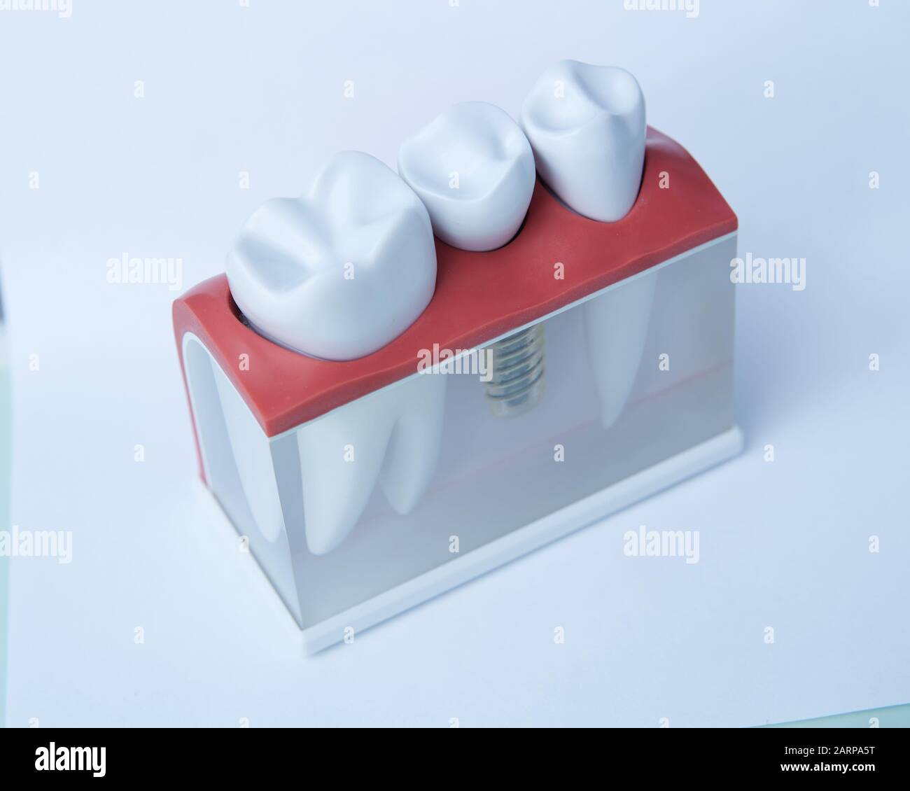 This model shows that teeth have been capped and the stainless pin in