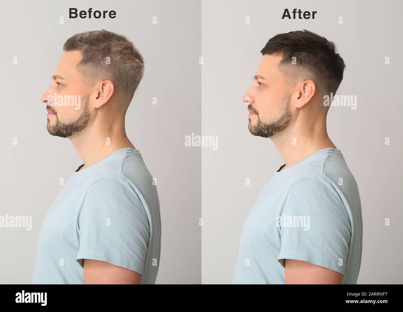 Man before and after hair loss treatment on grey background Stock Photo -  Alamy