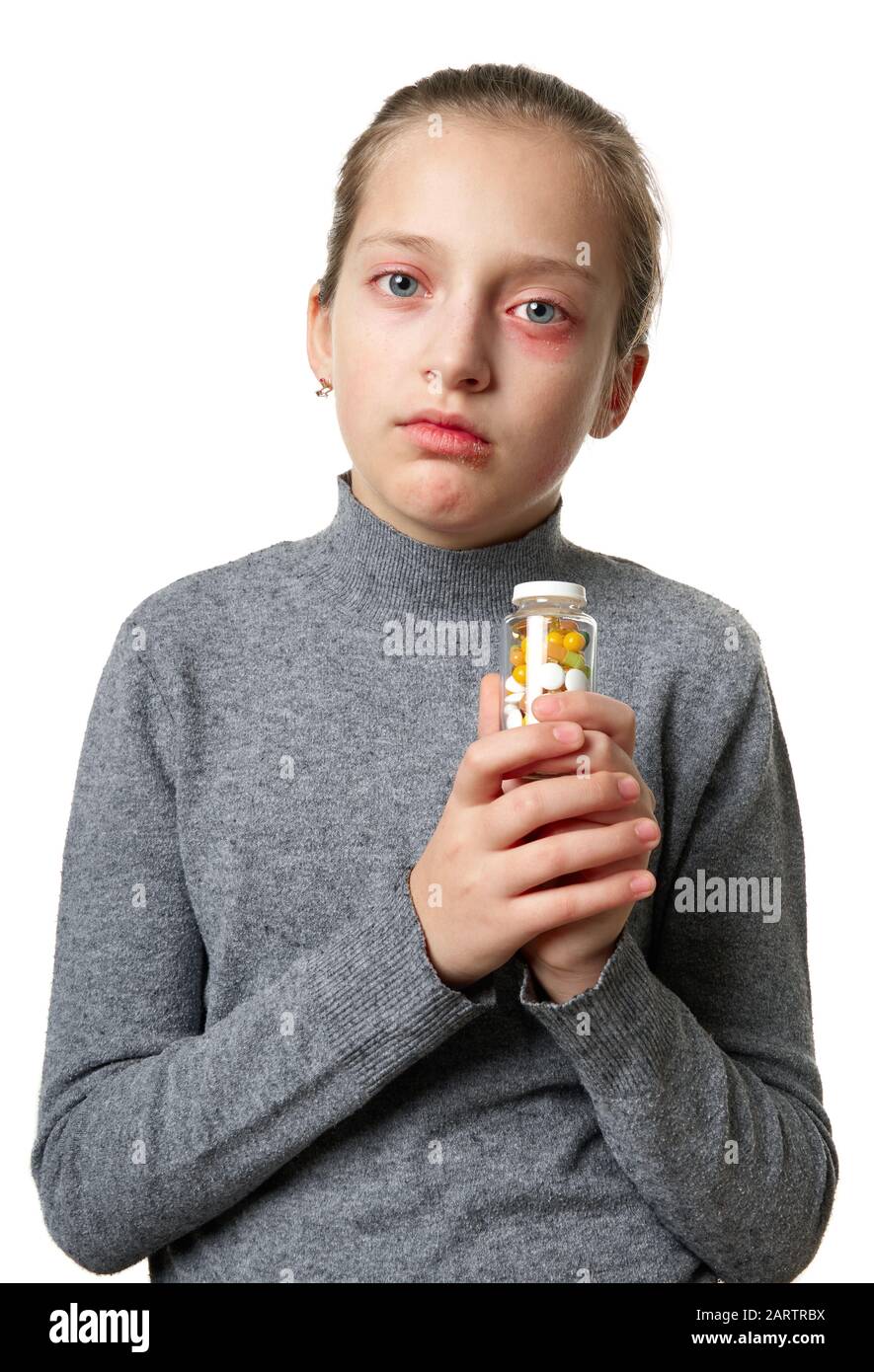 Allergic reaction, skin rash, close view portrait of a girl's face. Redness and inflammation of