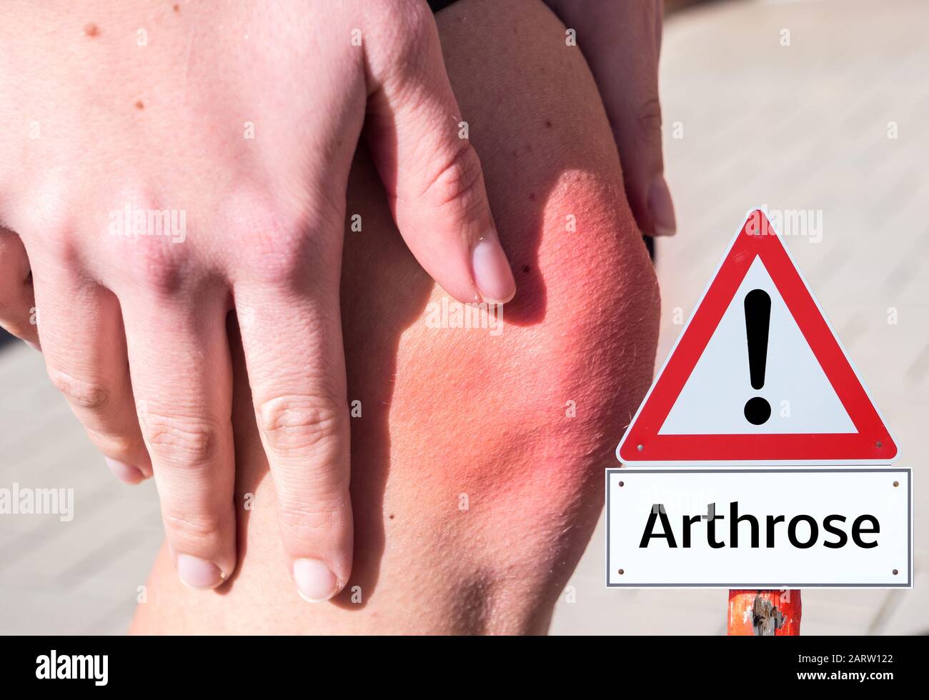 'Arthrose' warning sign health in german Stock Photo
