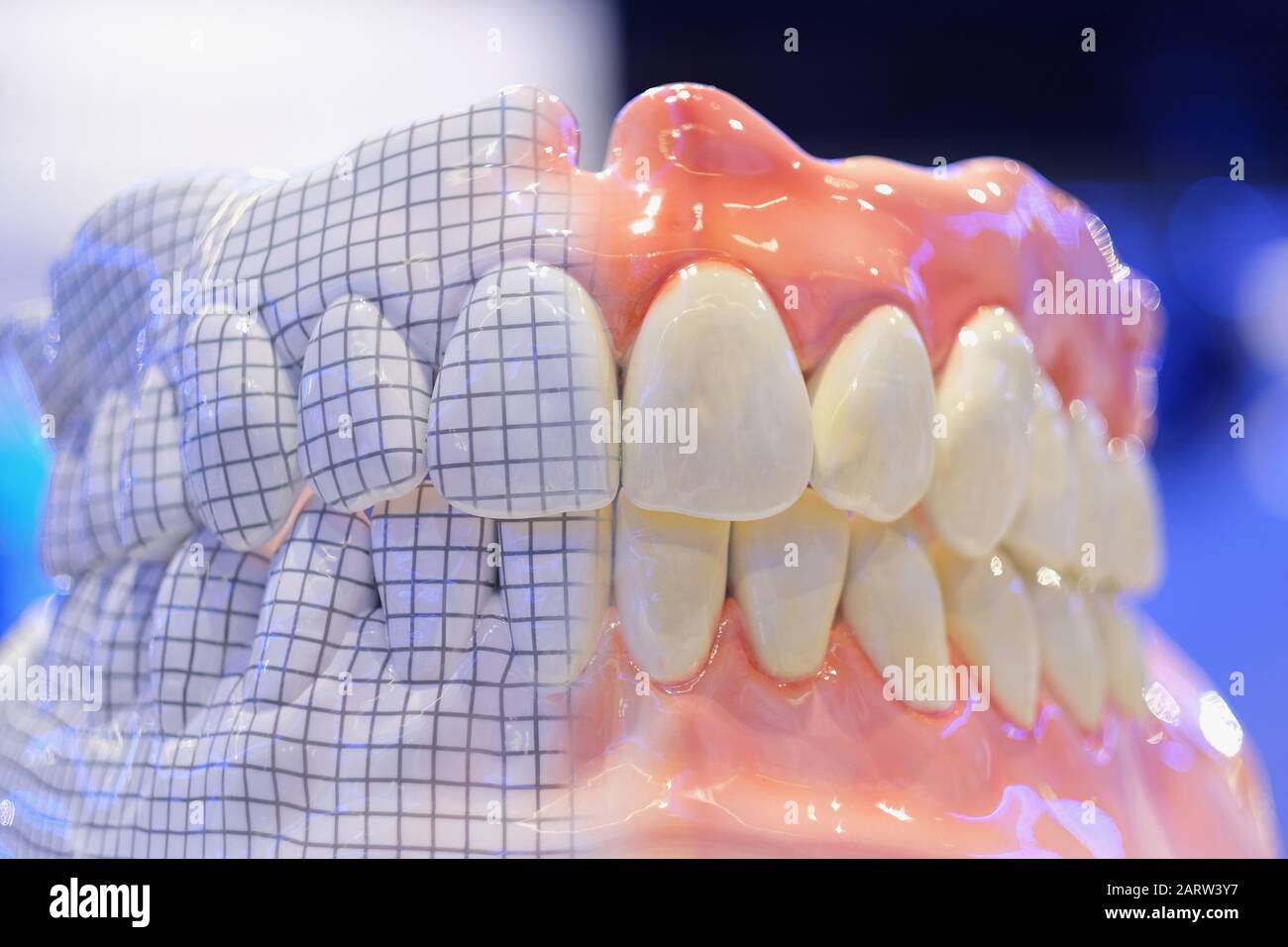 Samples of removable total prostheses of the upper and lower jaws Stock Photo