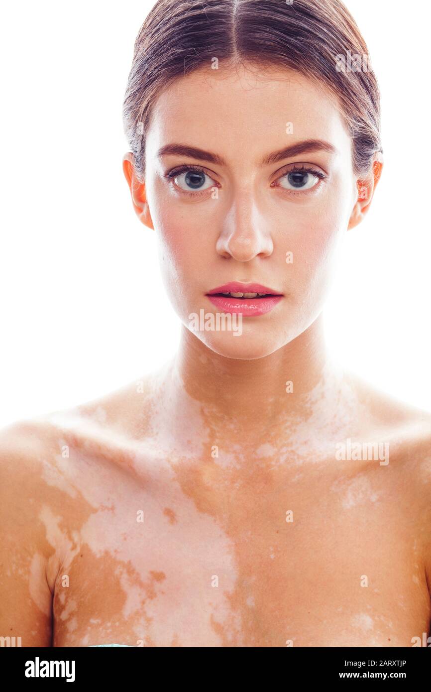 beautiful young woman with vitiligo disease isolated on white positive smiling, model