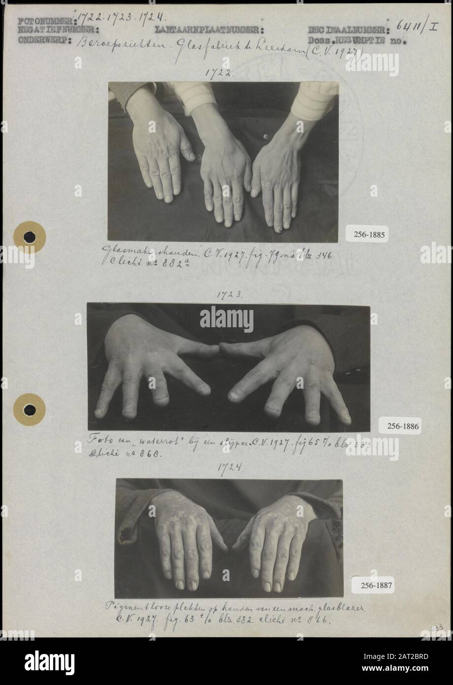 Occupational diseases at the glass factory in Leerdam Photo 1 Hands of