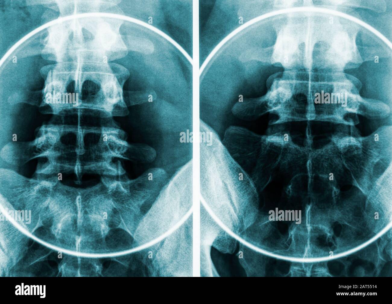 X-ray imagery or radiography of human male pelvis and lumbar vertebrae. Stock Photo