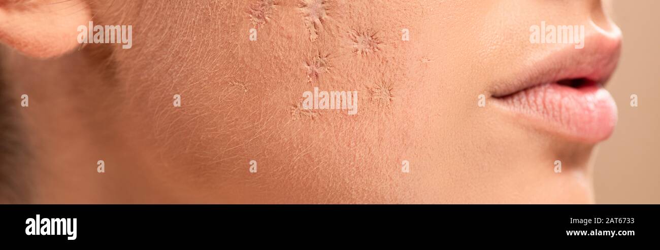 Blemished skin hi-res stock photography and images - Alamy