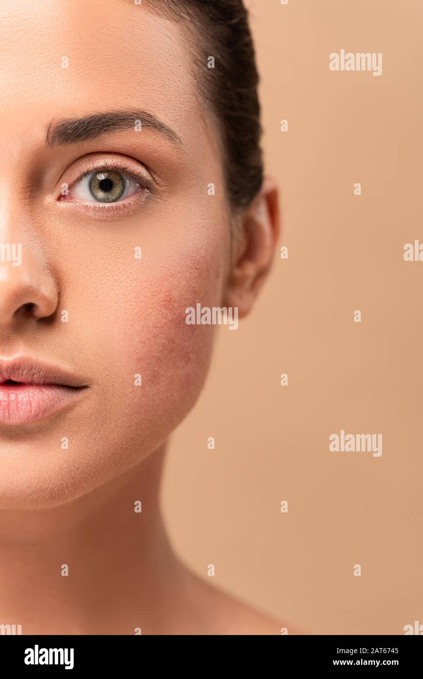 Blemished skin hi-res stock photography and images - Alamy