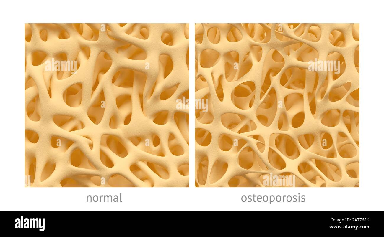 Porous bone hires stock photography and images Alamy