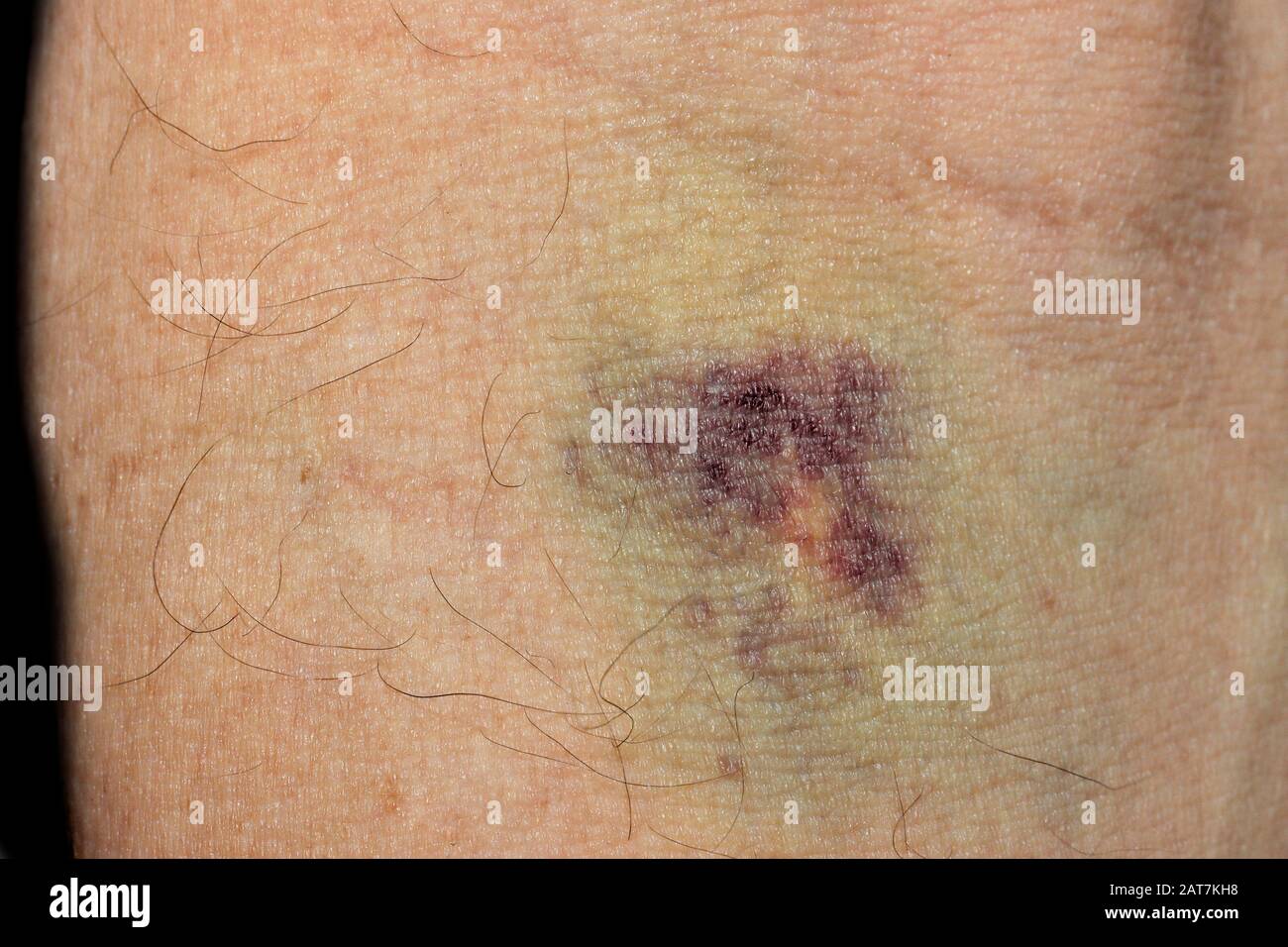 Haematoma hires stock photography and images Alamy