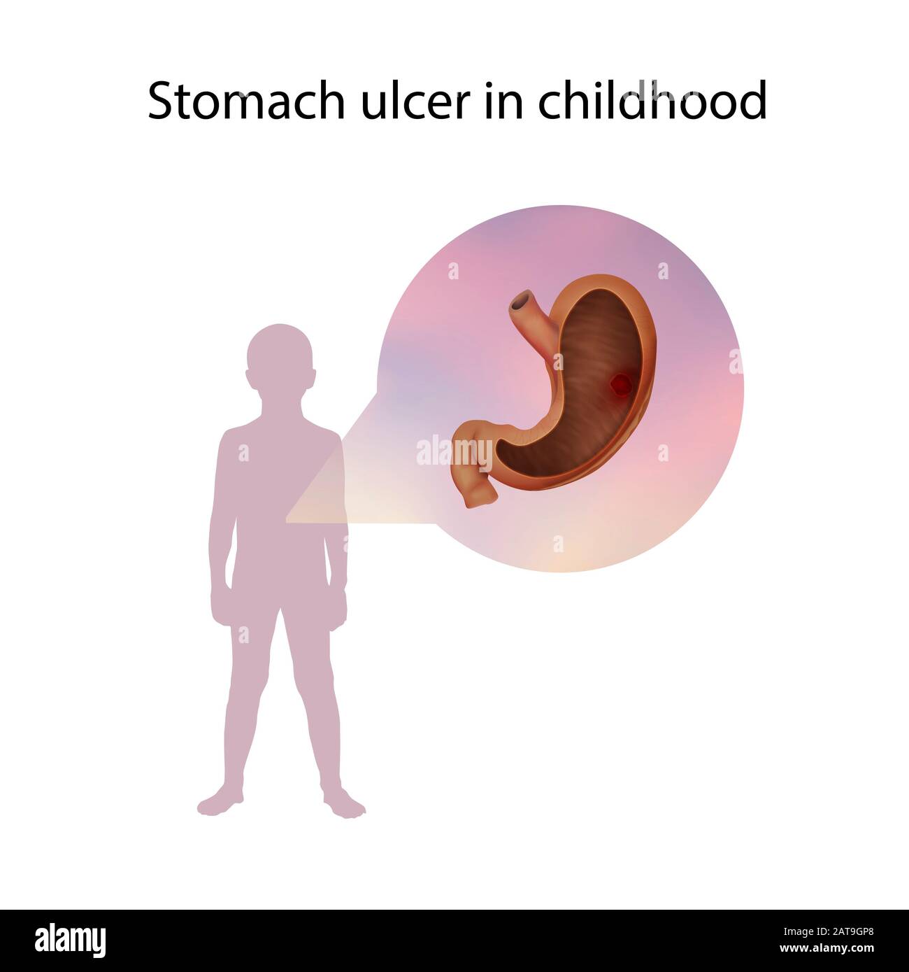 Stomach ulcer in childhood, illustration Stock Photo