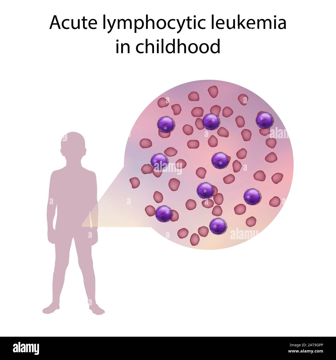 Acute lymphocytic leukaemia in childhood, illustration Stock Photo