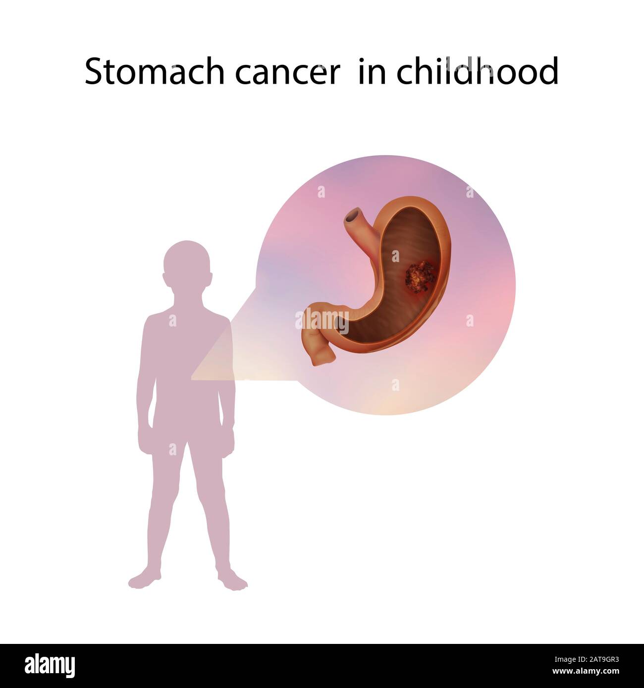 Stomach cancer in childhood, illustration Stock Photo Alamy
