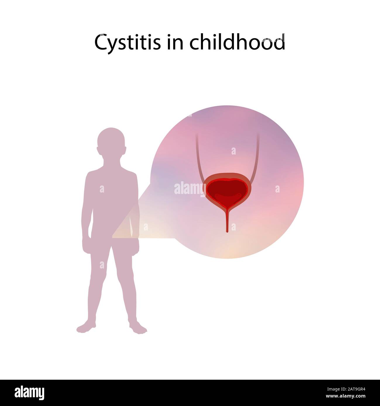 Cystitis in childhood, illustration Stock Photo