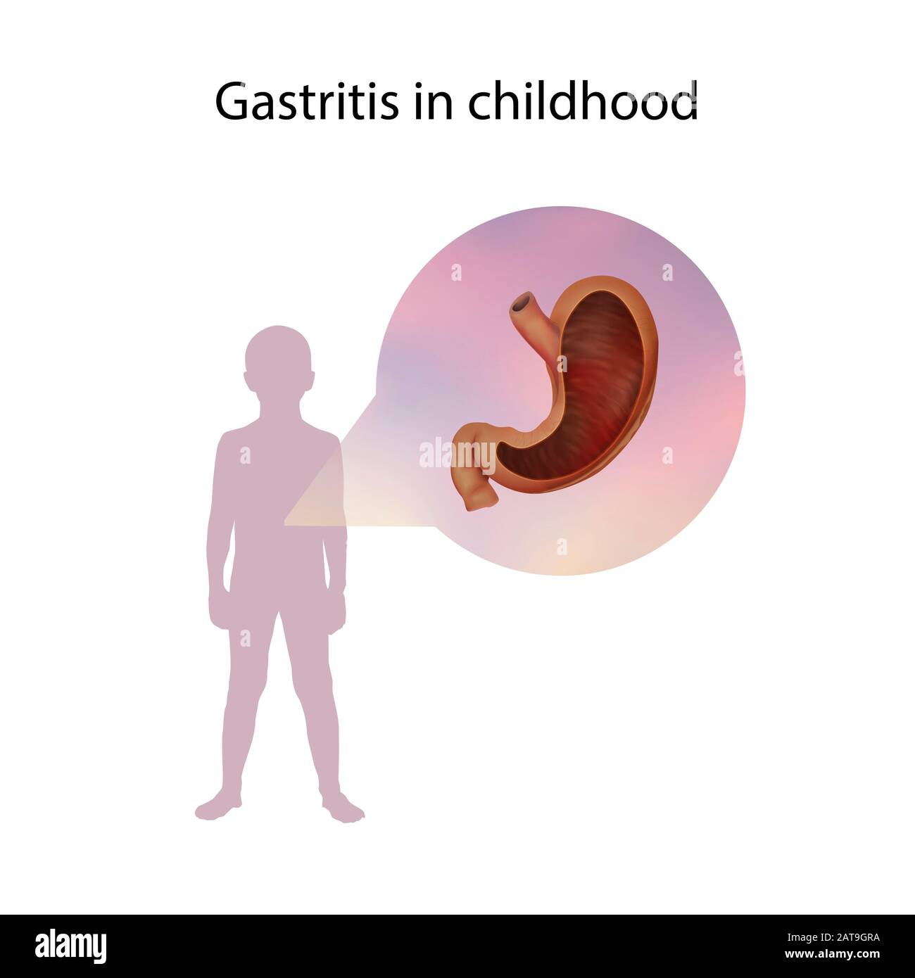 Gastritis in childhood, illustration Stock Photo