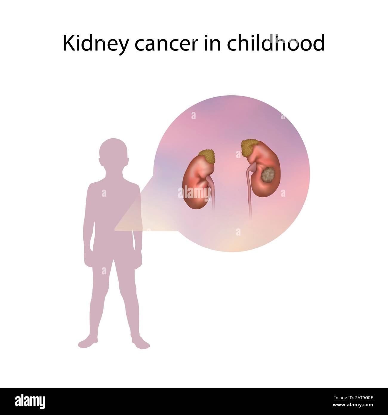 Kidney cancer in childhood, illustration Stock Photo
