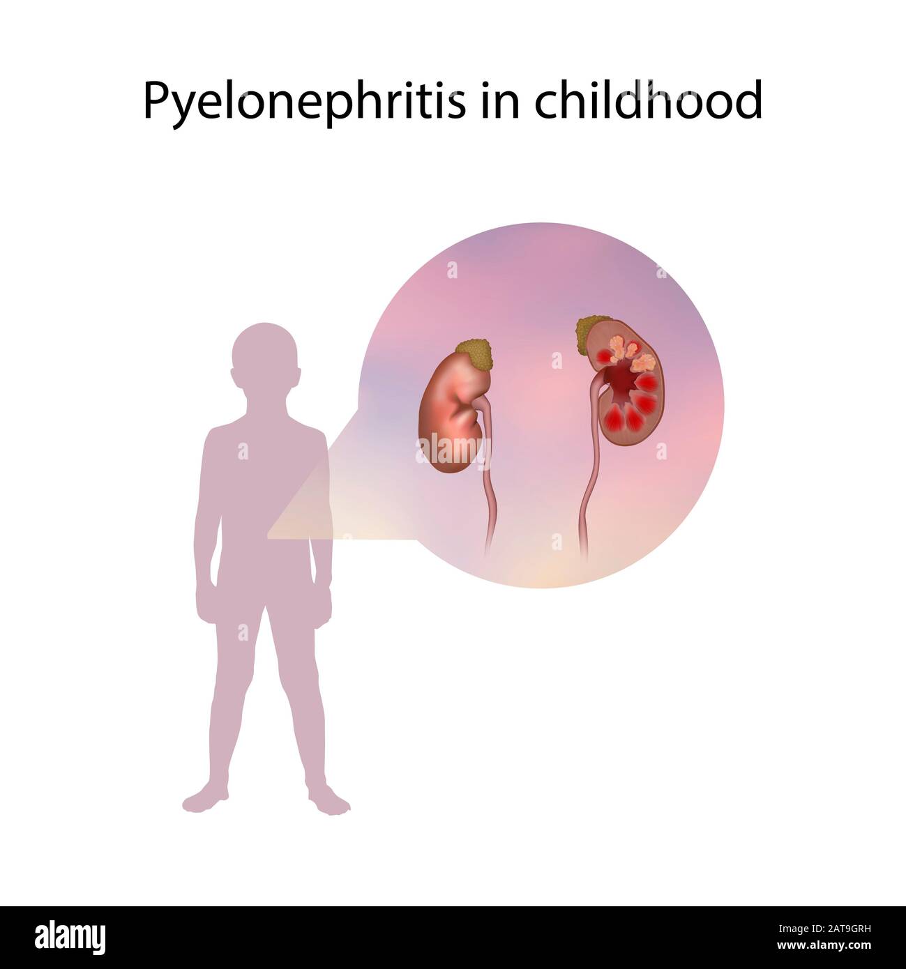 Pyelonephritis in childhood, illustration Stock Photo