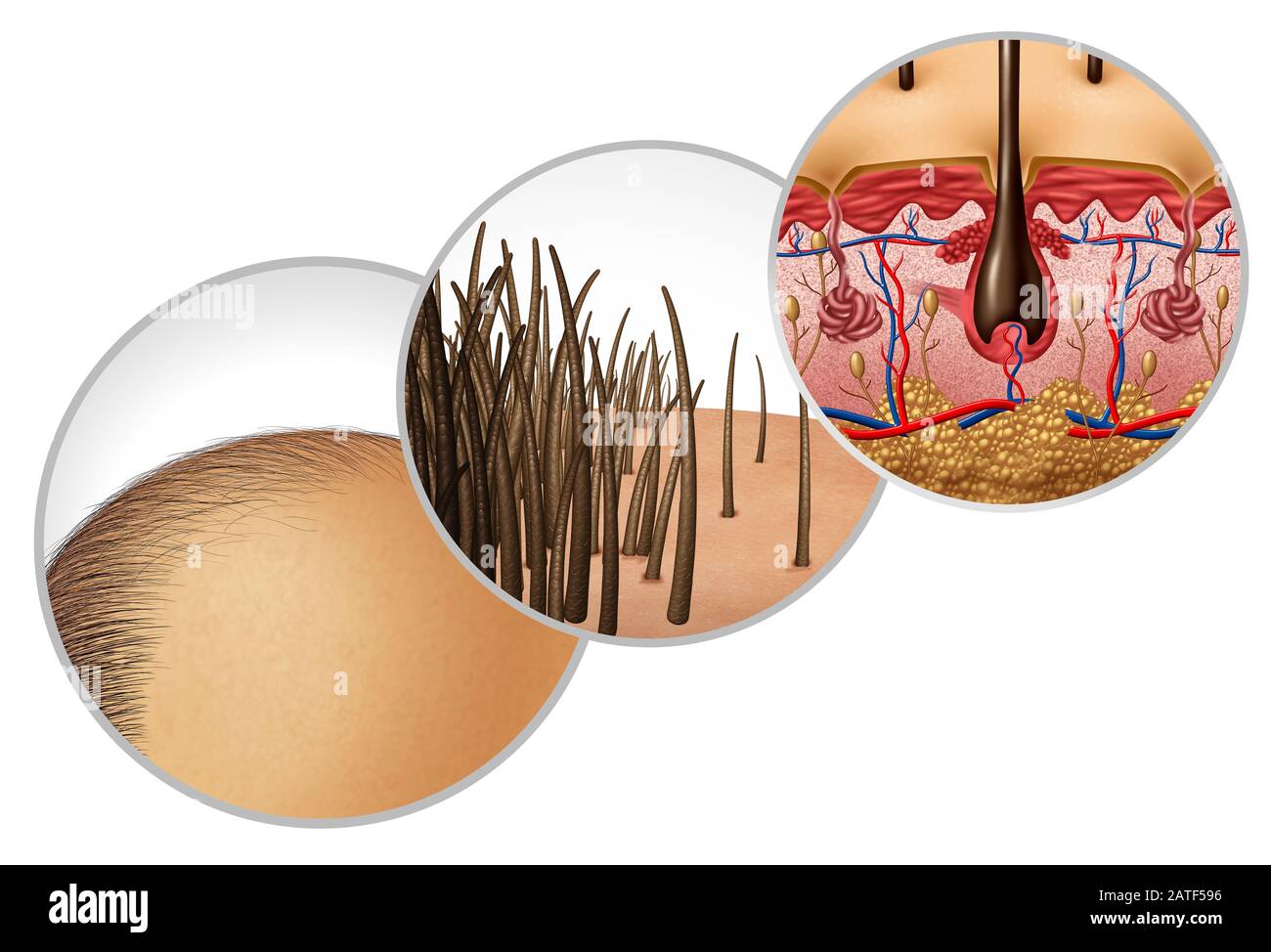Hair loss diagram and baldness or bald head hair loss as a receding hairline cosmetic follicle thinning and alopecia as a close up of skin anatomy Stock Photo - Alamy Hair loss diagram and baldness or bald head hair loss as a receding hairline cosmetic follicle thinning and alopecia as a close up of skin anatomy Stock Photo - Alamy
