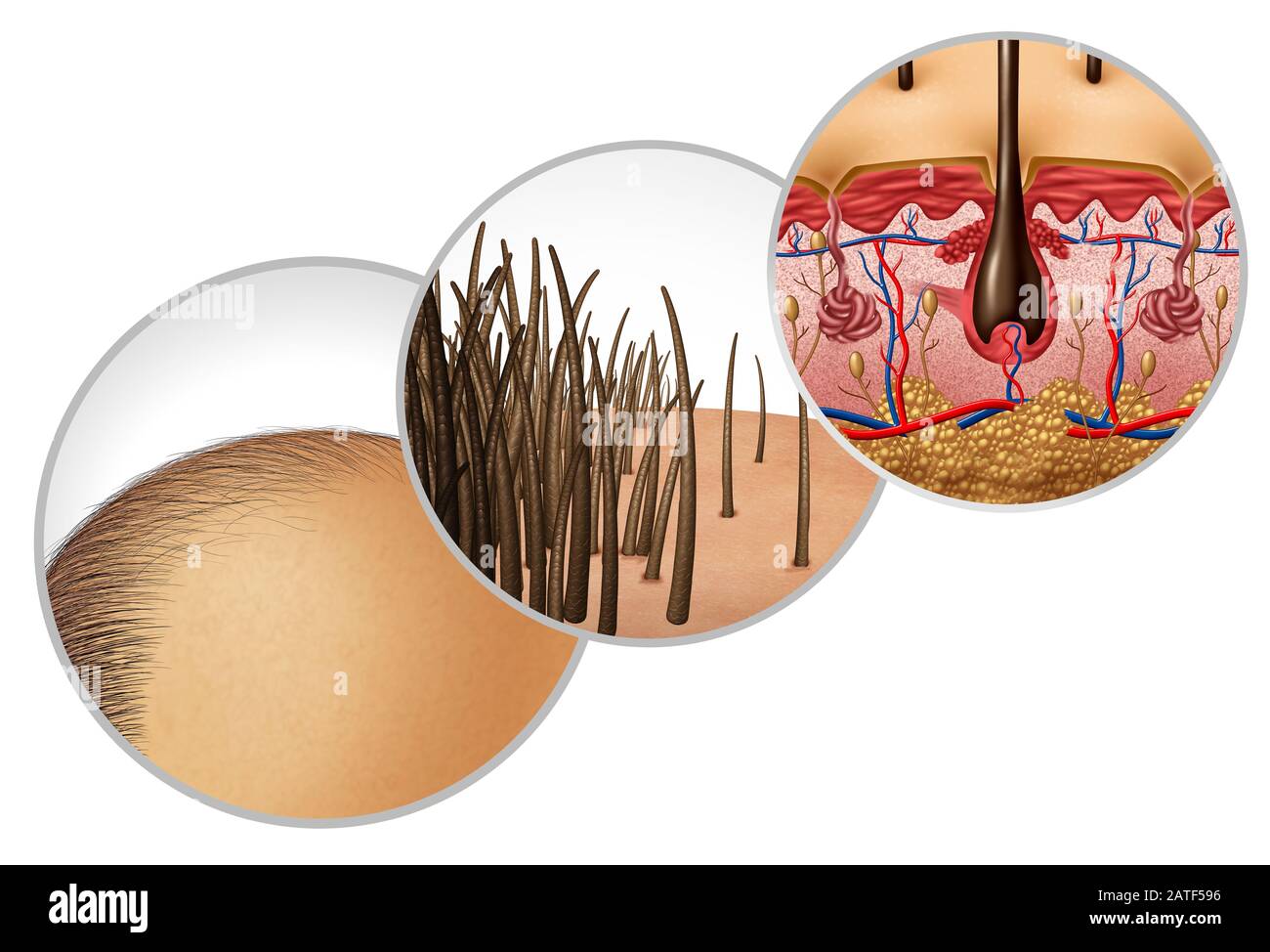 Hair loss diagram and baldness or bald head hair loss as a receding hairline cosmetic follicle thinning and alopecia as a close up of  skin anatomy. Stock Photo