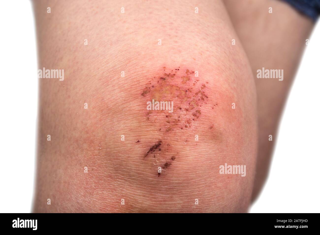 Woman scratch skin on the knee. Injury concept Stock Photo - Alamy