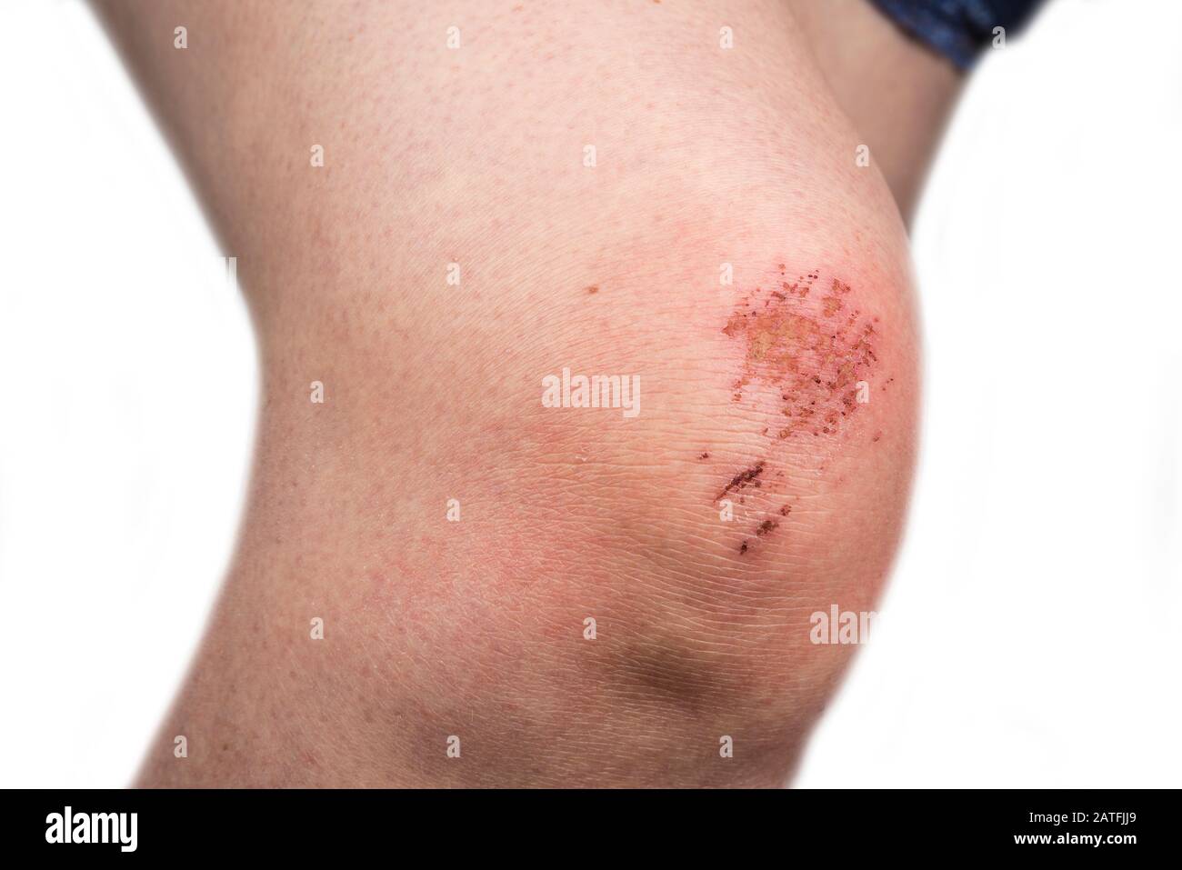 Scratch skin hi-res stock photography and images - Alamy