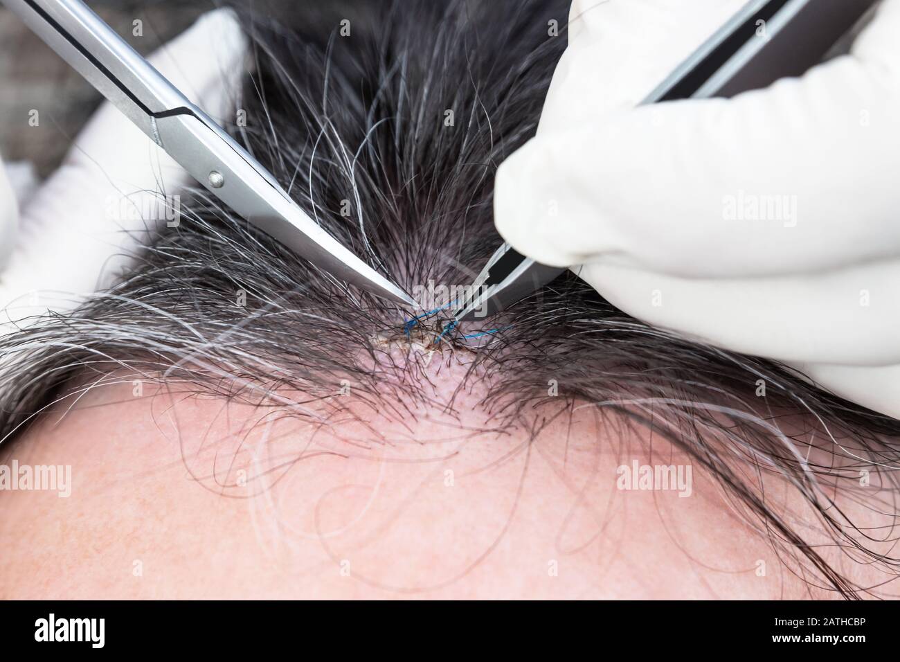 Head wound stitches hires stock photography and images Alamy