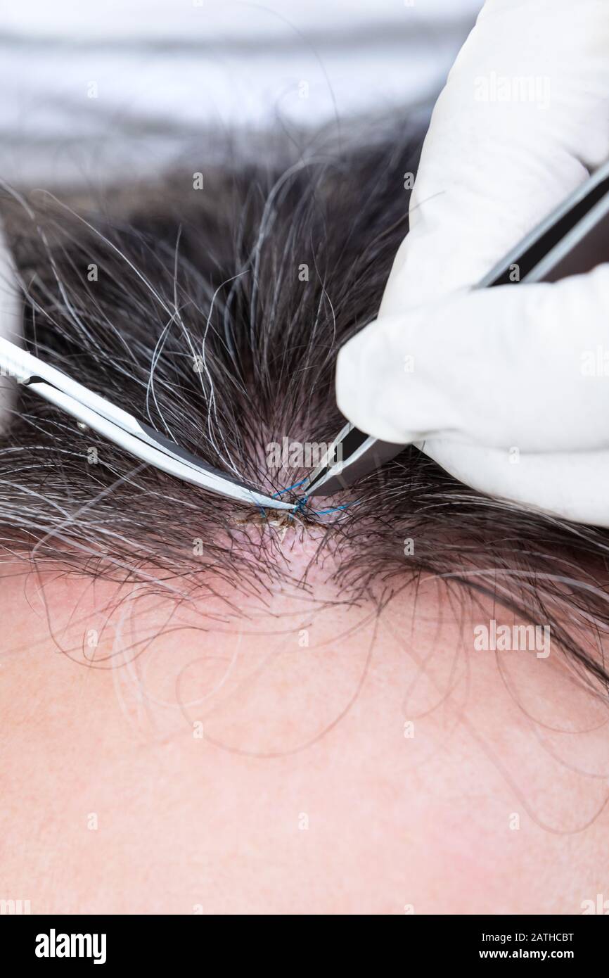 Removing stitches hires stock photography and images Alamy