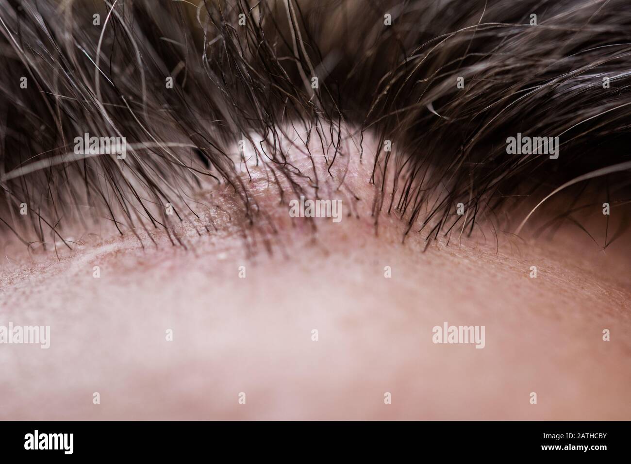 Closeup of a male head with an atheroma or lipom Stock Photo
